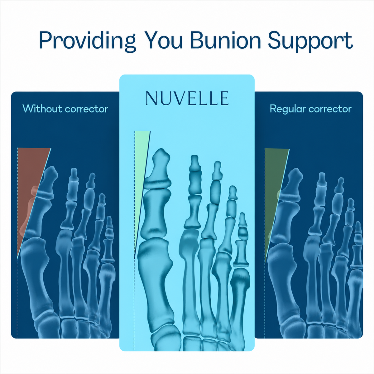 Realyn Pro — EMS Toe Alignment Support